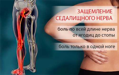 После нескольких раз боли утихнут благодаря снятию напряжения в спине