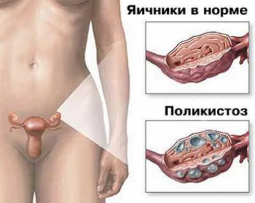 Такое образование способно исчезнуть самостоятельно через цикла месячных