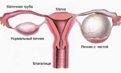 Как влияет киста на месячные причины