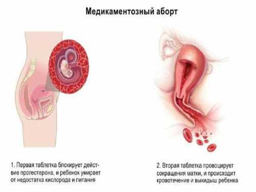 На каких сроках можно сделать медикоментозный аборт