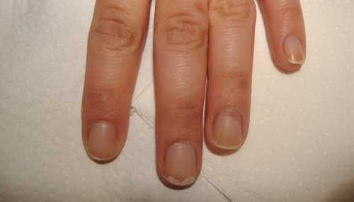 Чем бы ни было спровоциро вано отслоение ногтя от ногтевого ложа, лечение должно быть своевременным и эффективным