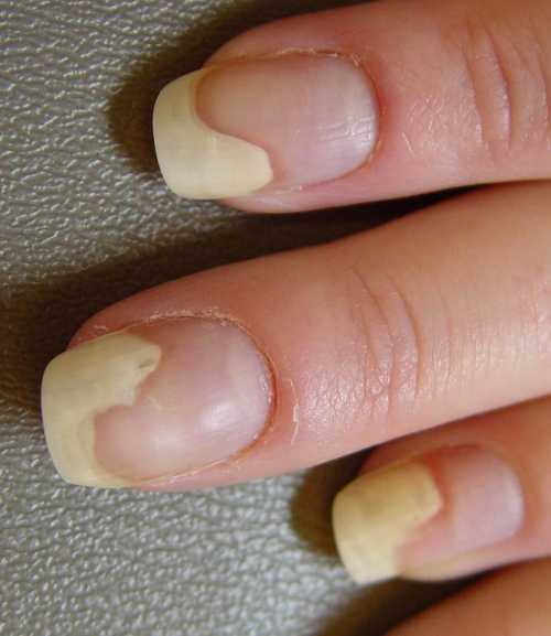 Как лечить отслоение ногтя
