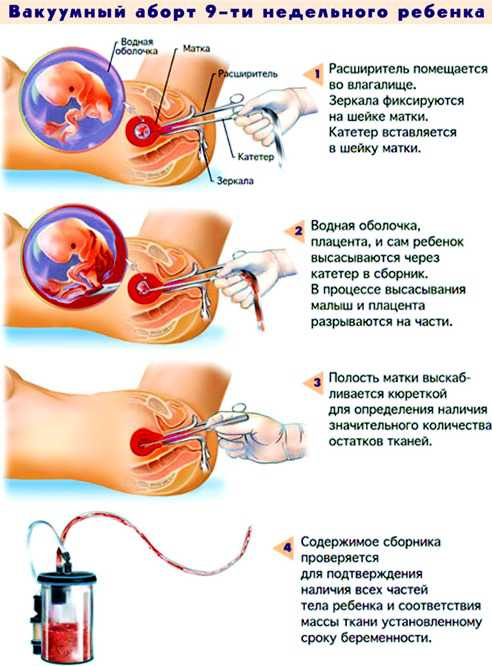 Медикоментозный абборт до скольки недель