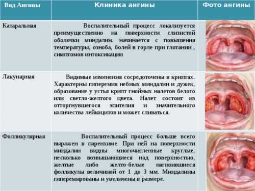 Грибковая ангина