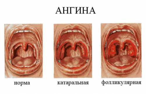 Может сопровождаться повышенным слюно течением и болью в сердце