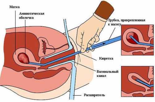 Месячные после чистки матки