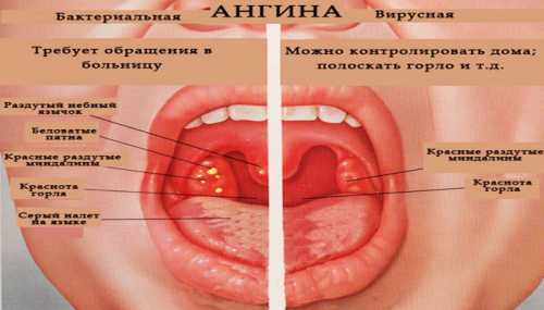 Как передается ангина