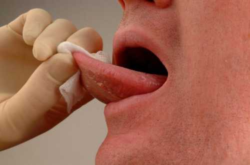 Туберкулез слизистой рта, как правило, является вторичным проявлением туберкулеза легких