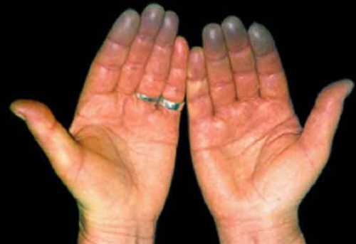 Руки немеют изза того, что нервы начинают плохо работать в результате плохого кровотока