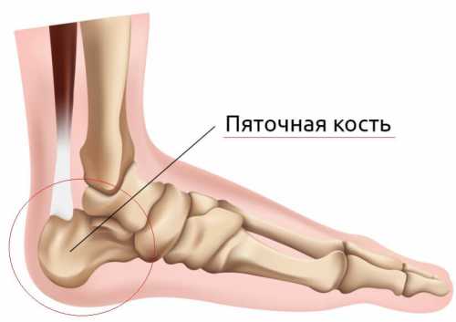 У каждого боль может быть разной периодической, когда наступаешь на пятку, или постоянной ноющей, сменяющейся острой при ходьбе