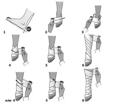 Для им мобилизации голеностопного сустава эластичным бинтом требуется сам бинт и специальные зажимы для фиксации