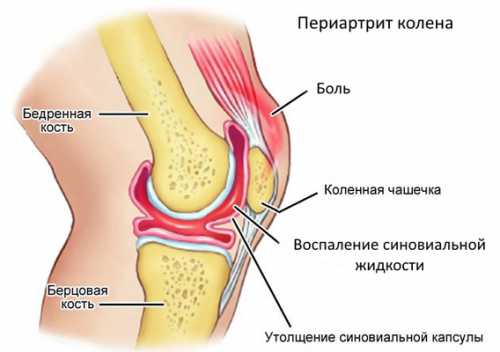 Ноющая боль в колене